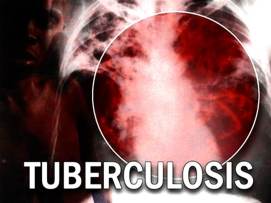 bahaya penyakit tbc pada anak